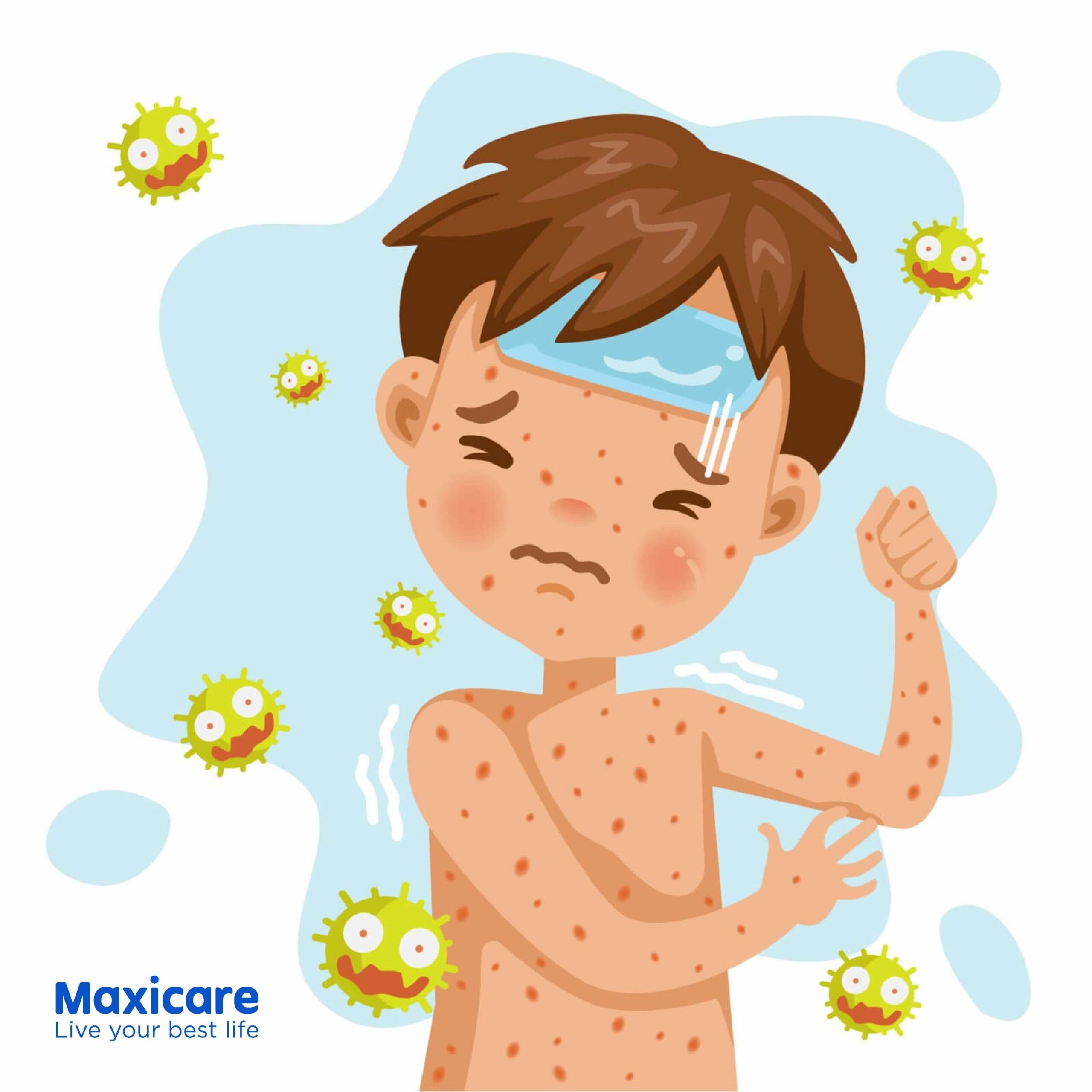 Chickenpox What You Need to Know