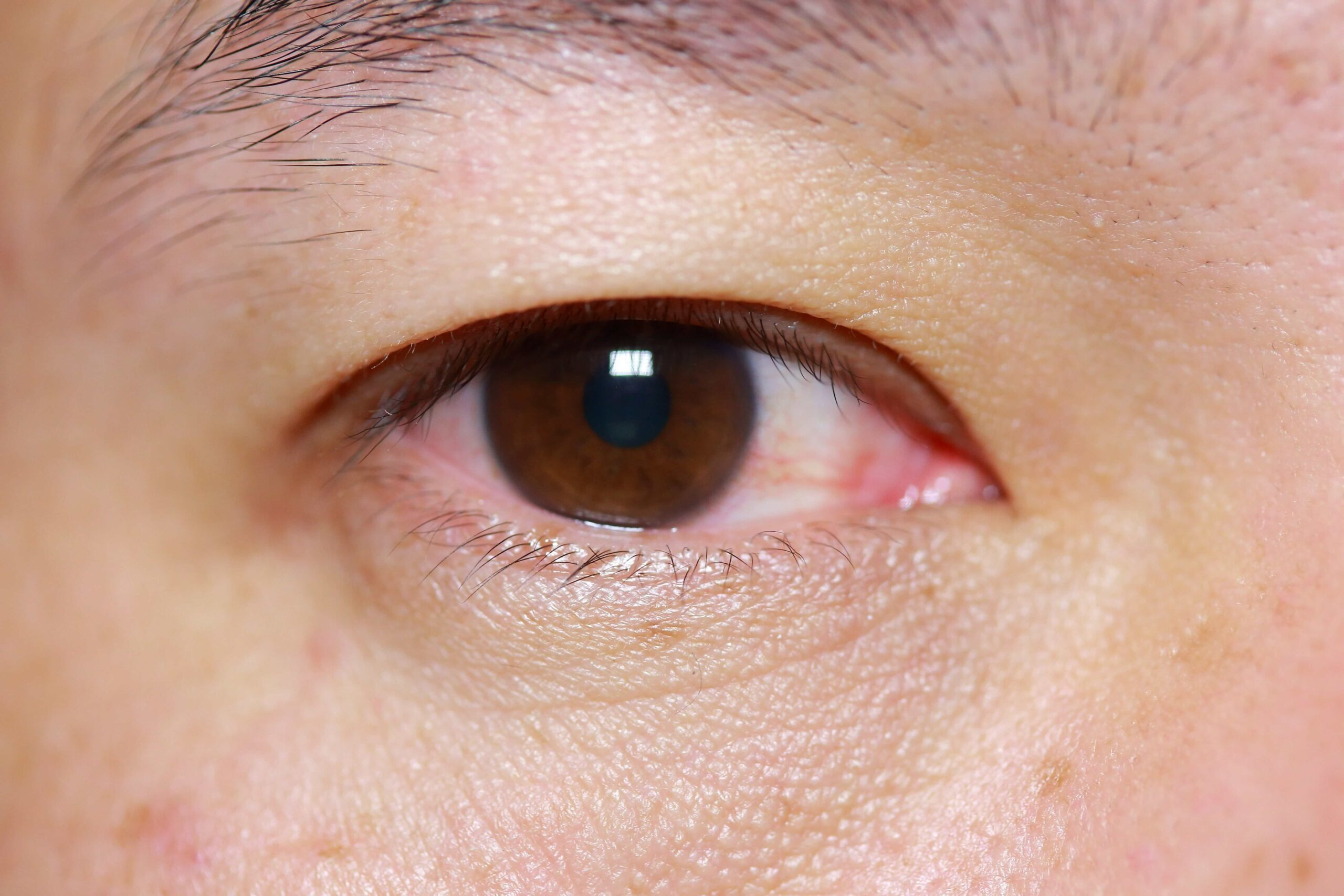 How to protect yourself and others from “Pink Eye”